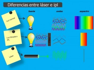 Diferencias entre Laser e IPL
